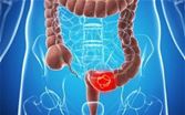 دراسة: النظام الغذائي منخفض البروتين يقتل أورام سرطان القولون